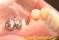 抜歯即時無切開インプラントの治療例1