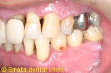 重度の歯周炎になるとフレアーアウトになります