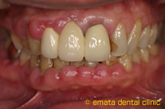重度の歯周炎の治療2