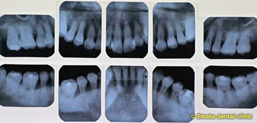 中程度の歯周病の治療例4