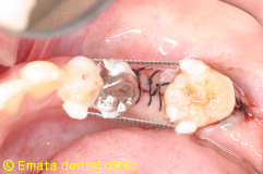 歯牙移植手術