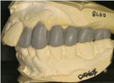 左上・右下奥歯はインプラント治療を希望され診断用ワックスアップ